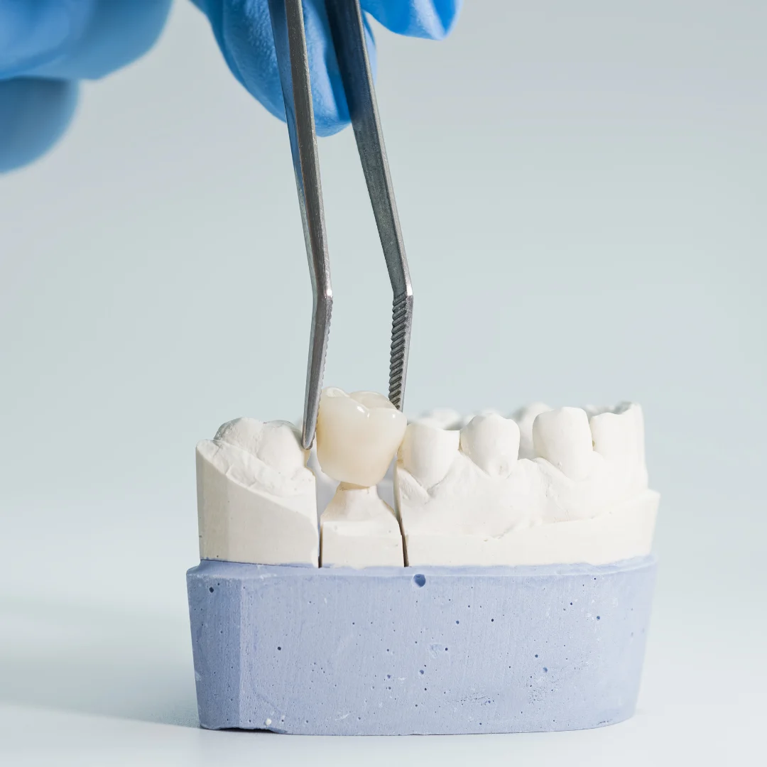 Dental crown placement on plaster tooth model